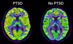 Color-enhanced brain scan comparing activity in a brain with PTSD and one without, highlighting changes in the hippocampus, amygdala, and prefrontal cortex.